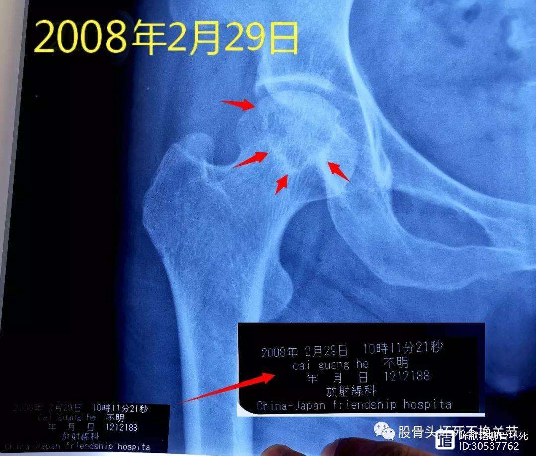 淮北人工骨头医保报销多少(人工骨头医保报销多少比例)